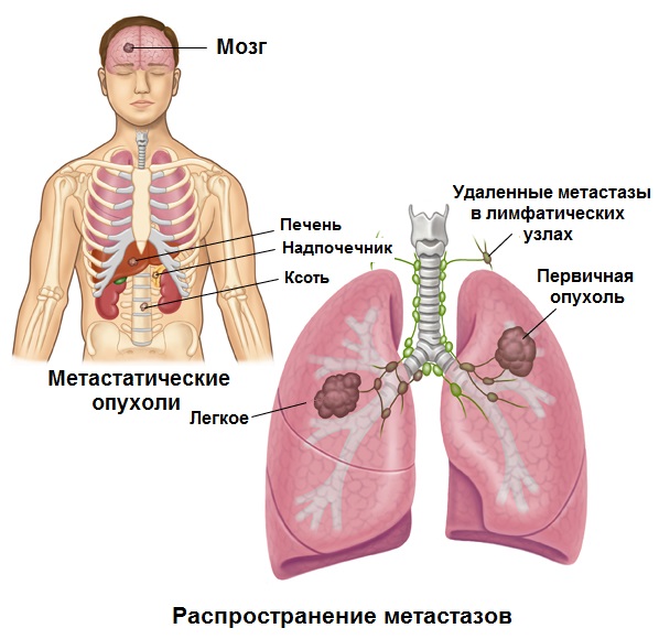 Метастазирование