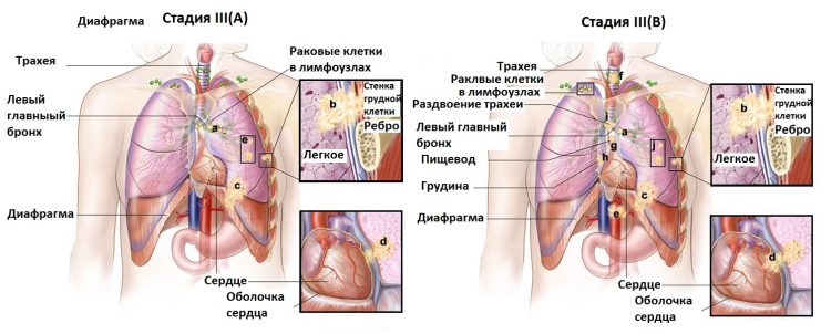 Рак легких 3 стадии: вся информация о патологии