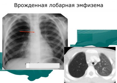 Врожденная лобарная эмфизема