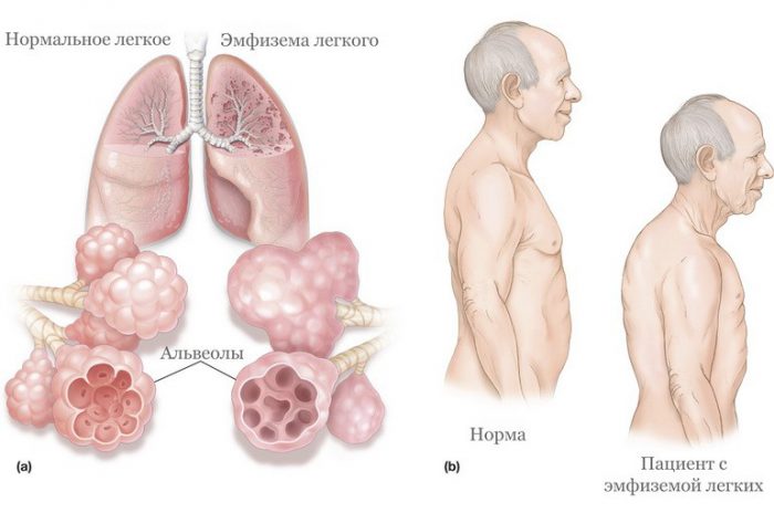 Эмфизема легких