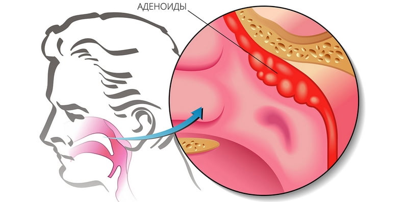 Аденоиды