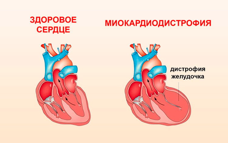 Дистрофия миокарда
