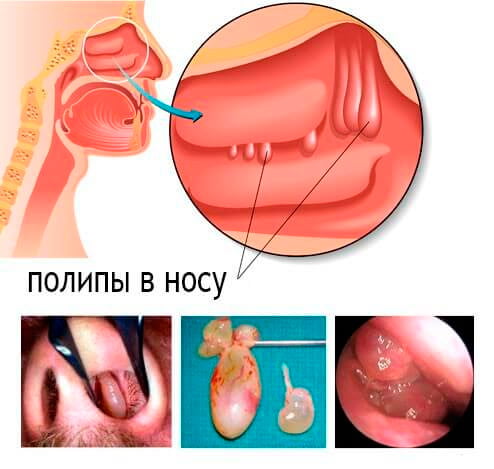 Полипы в носу