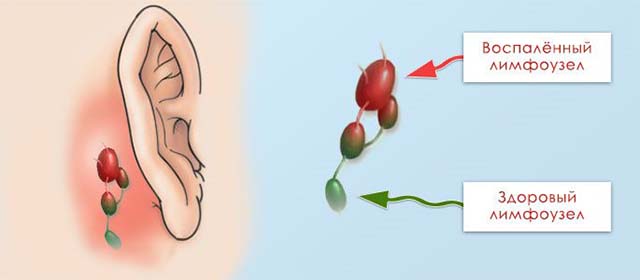 Лимфаденит за ушами