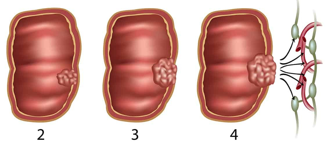 Стадии рака кишечника. Опухоль прямой кишки на 3 стадии. Стадии опухоли толстой кишки.