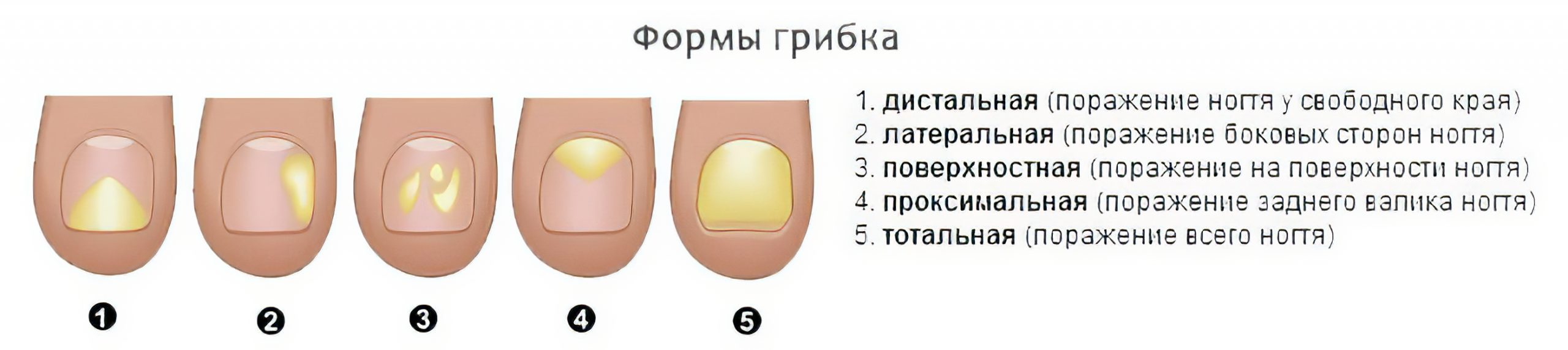 Как понять что ногтевая пластина сформировалась. Дистальный подногтевой онихомикоз. Латеральная форма онихомикоза. Дистально-латеральный Тип онихомикоза. Гипертрофический онихомикоз.