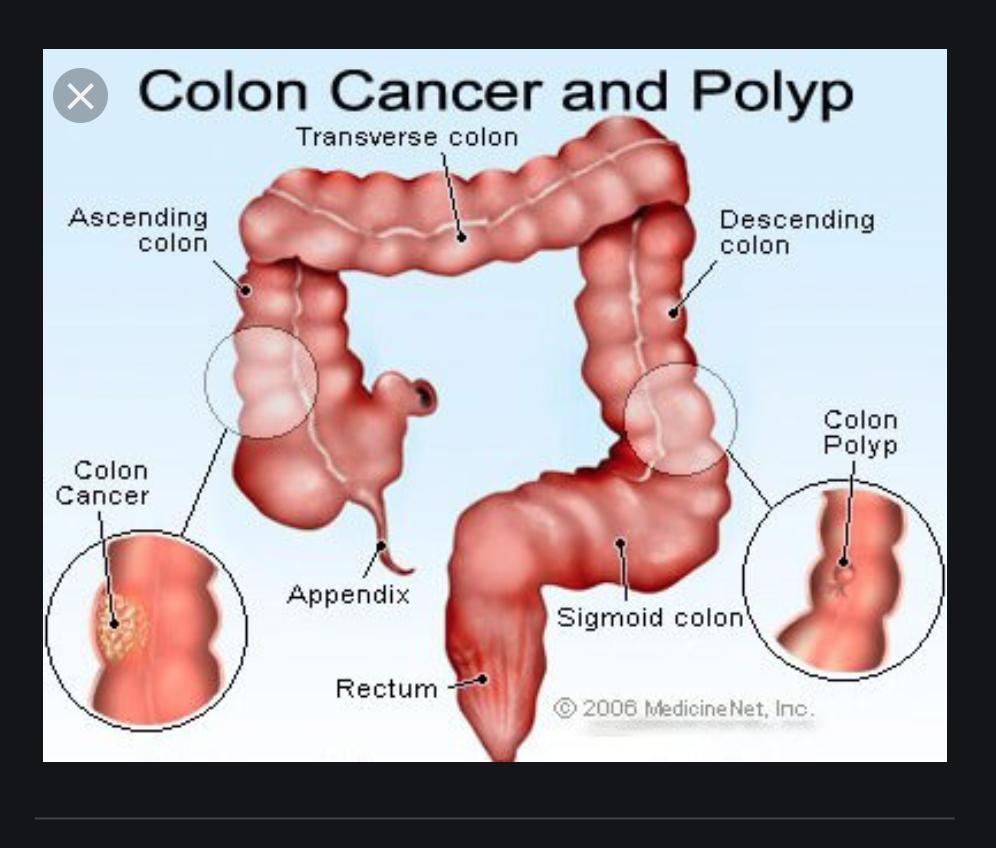 Признаки рака кишечника у мужчин на ранних. Неоплазия сигмовидной кишки. Неоплазия в ободочной кишке. Злокачественная опухоль ободочной кишки. Раковая опухоль толстой кишки.