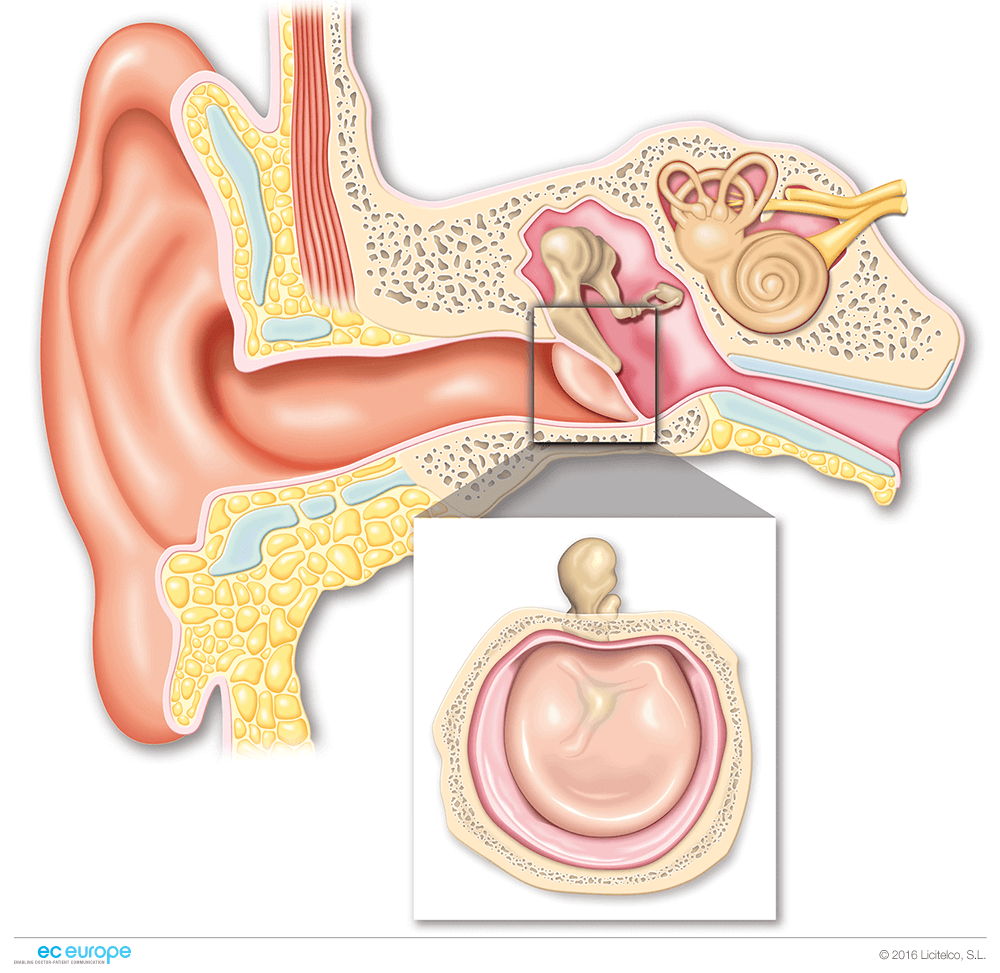 Лечение воспаления среднего уха у взрослых. Буллёзный отит барабанная перепонка. Тубоотит барабанная перепонка. Острый катаральный отит.