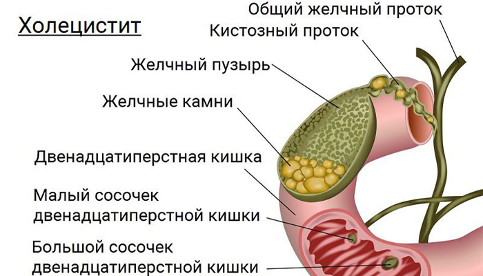 Анатомия холецистита