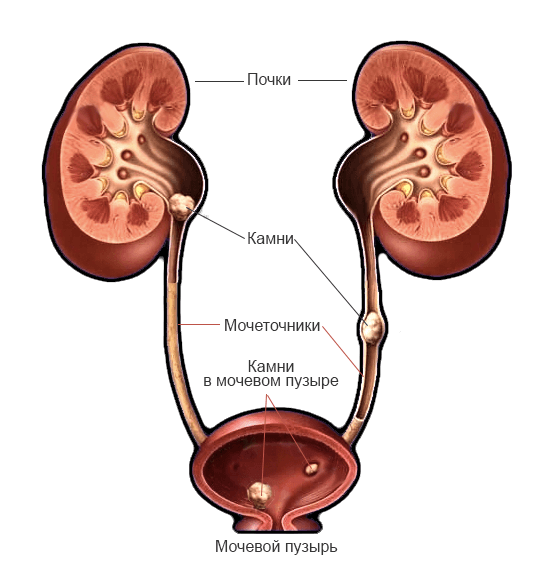 Мочекаменная болезнь 