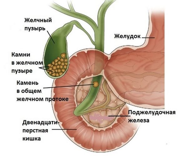 Камни в желчном пузыре анатомия