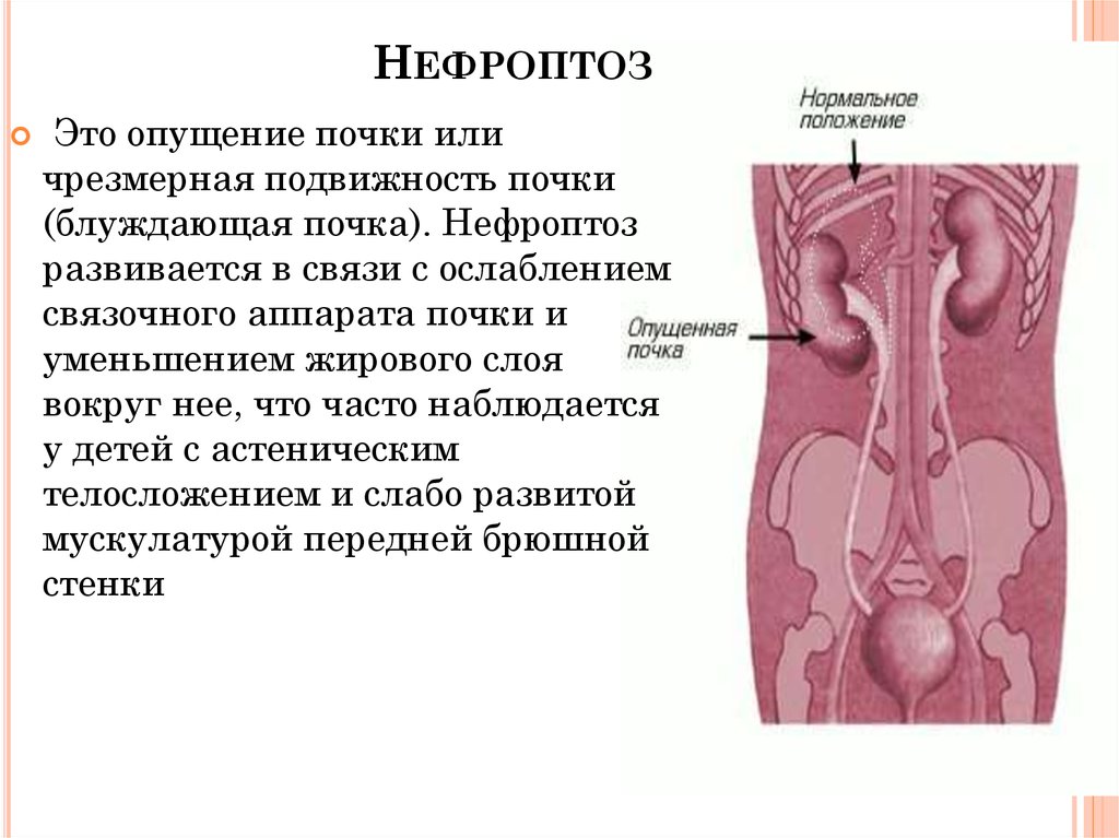 Определение нефроптоза почек