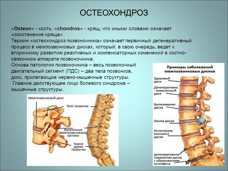 Определение остеохондроза позвоночника