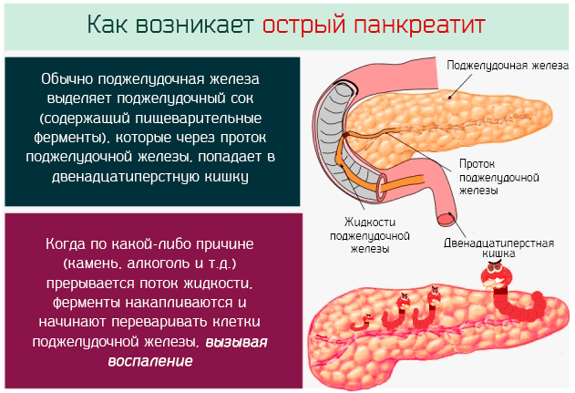 Как возникает острый панкреатит