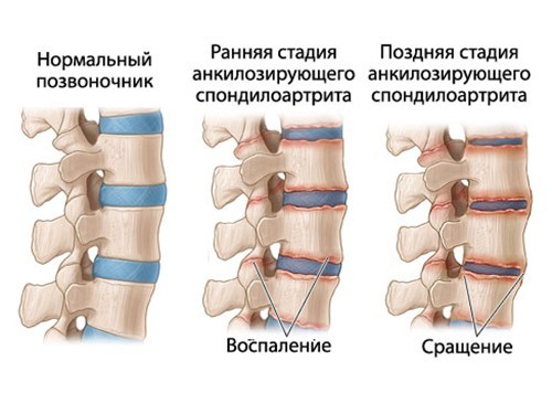 Стадии спондилоартрит