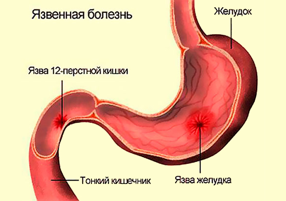 Язва желудка и двенадцатиперстной кишки