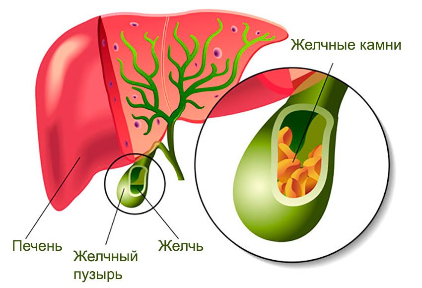 Камни в желчном пузыре