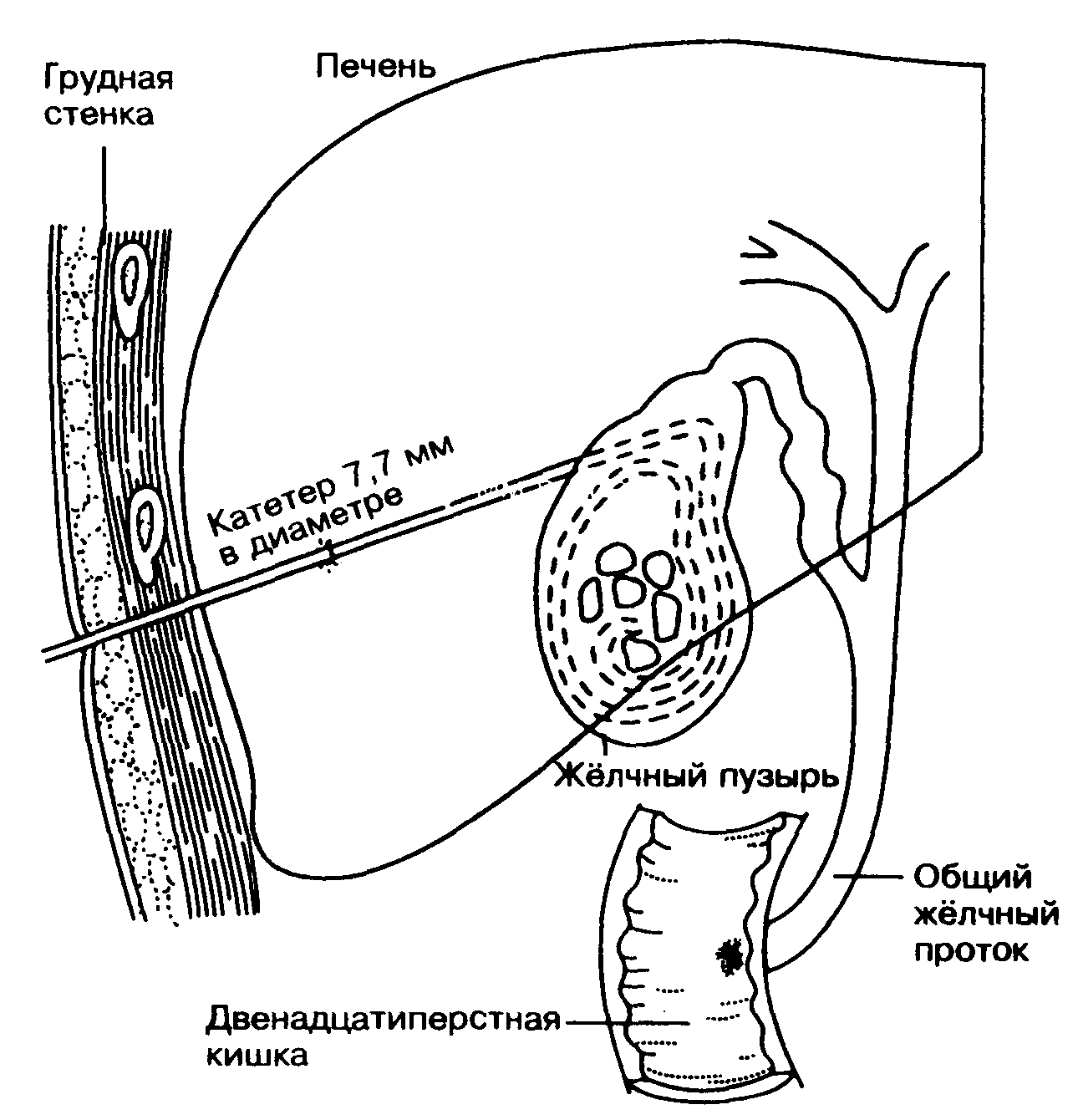 Схема проведения чрескожного литолиза