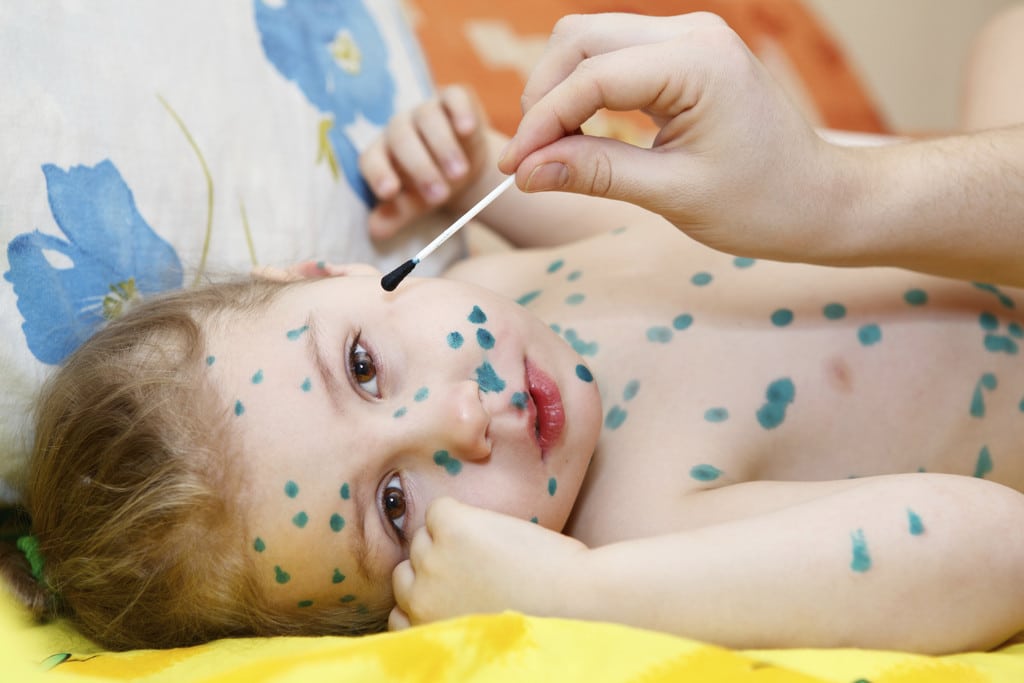 Treatment of chicken pox