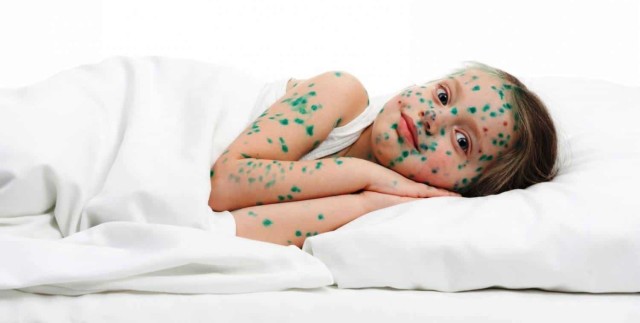 chicken pox in children