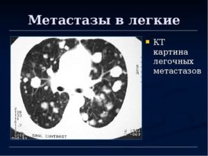 Метастазы в легких на кт