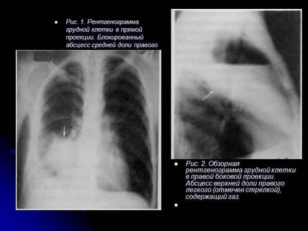 Пневмония в правом легком в нижней доле. Абсцесс правого легкого рентгенограмма. Пневмония осложненная плевритом рентген. Рентгенограмма больного с абсцессом средней доли правого легкого. Пневмония средней доли правого легкого на рентгенограмме.