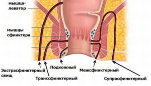 Виды свищей