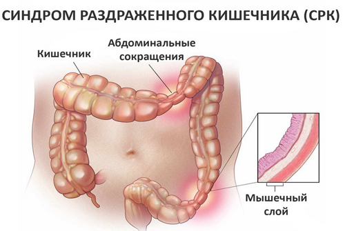 Синдром раздраженного кишечника