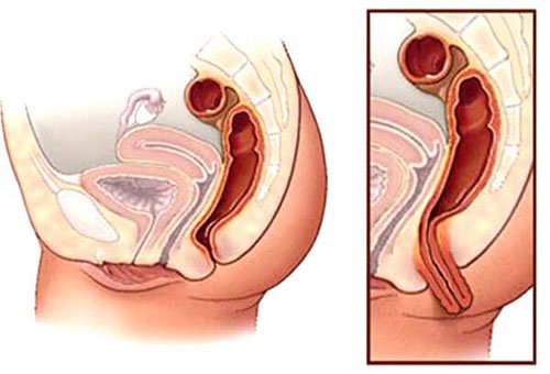 Выпадение прямой кишки