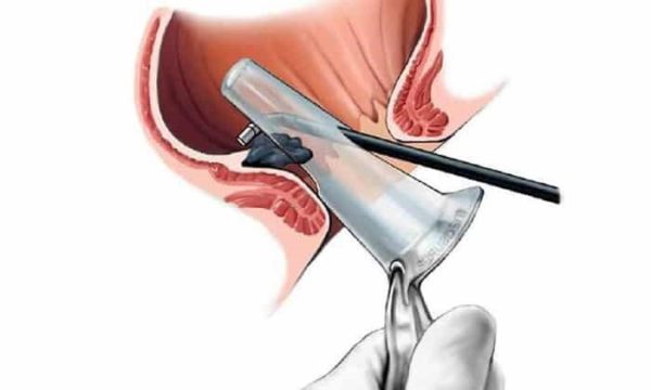 Лечение геморроя на поздних стадиях