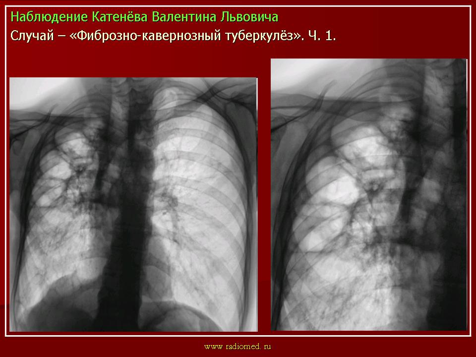 Фиброзно кавернозный туберкулез. Фиброзно-кавернозный туберкулез рентген. Каверна при фиброзно-кавернозном туберкулезе. Фиброзно кавернозный туберкулез обсеменение. Двусторонний фиброзно-кавернозный туберкулез легких рентген.