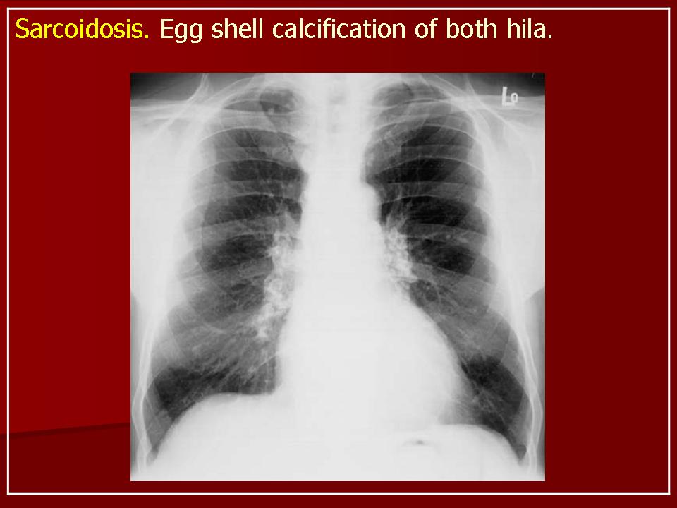 Саркоидоз это. Саркоидоз мягких тканей. Болезнь саркоидоз легких что это такое. Заболевания легких саркоидоз.