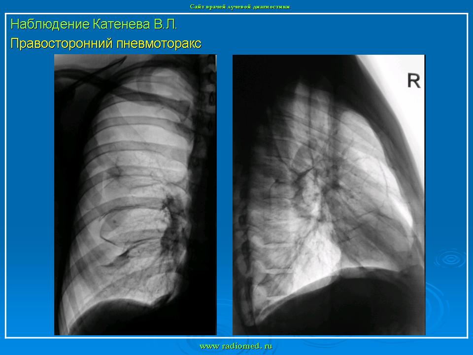 Легких форум. Осумкованный пневмоторакс. Рентген легкого осумкованный пневмоторакс.