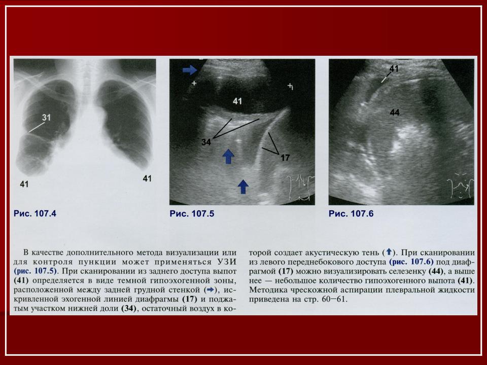 Узи плевральной полости. УЗИ плевральной полости легких. УЗИ плевральной полости туберкулезный плеврит. Диагностер УЗИ плевральных полостей. Экссудативный плеврит УЗИ плевральной полости.