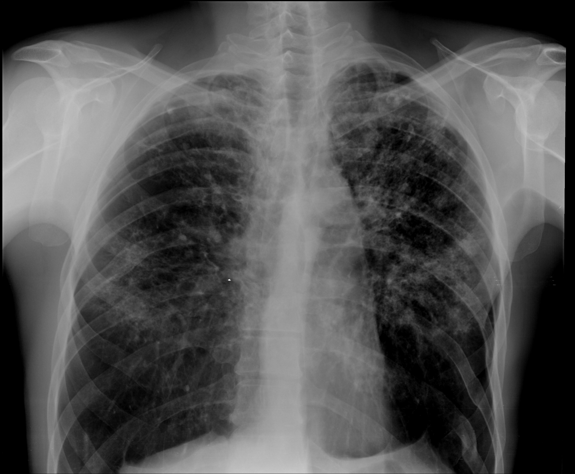 Диссеминированное поражение легких. Подострый диссеминированный туберкулез рентген. Милиарный туберкулез рентген. Гематогенно – диссеминированный туберкулез легкого рентген. Подострый диссеминированный туберкулез легких, рентгенография.