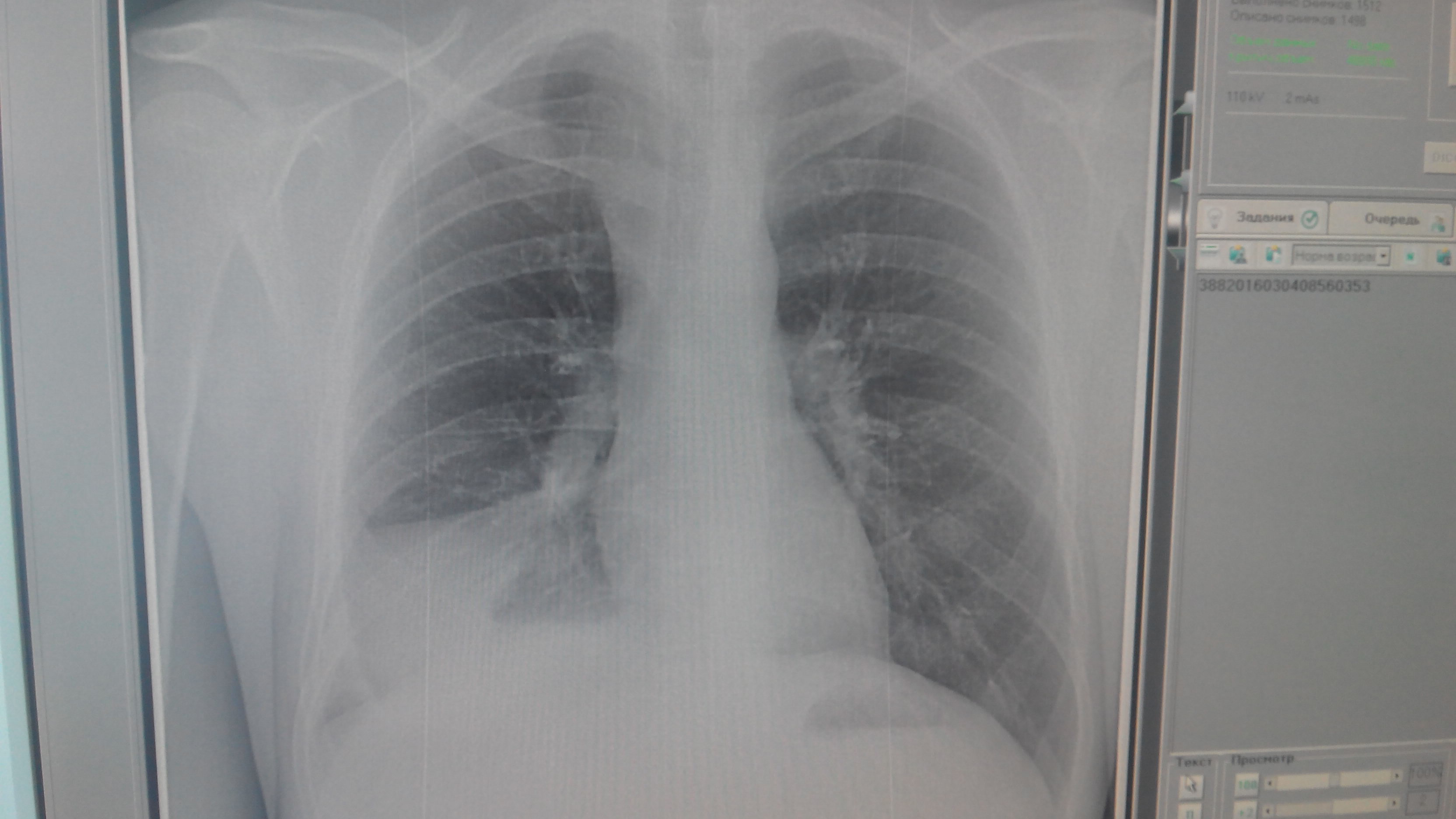 Затемнение нижних легких. Затемнение нижней доли правого легкого рентген. Затемнение на рентгенограмме легких. Лёгкие курильщика на рентгене. Затемнение на рентгене легких.