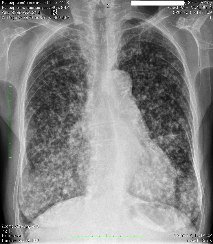 Легкие после пневмонии. Милиарный канцероматоз легких. Карциноматоз легких рентген. Ковиднаям пневмония на рентгене. Канцероматоз легких рентген.