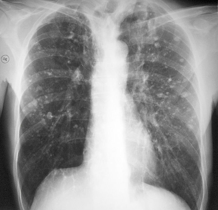 Затемнение нижних легких. Флюорография снимок туберкулез. Шаровидная пневмония рентген. Мелкоочаговая пневмония рентген. Флюорограмма туберкулеза.