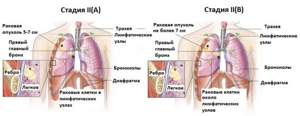 Симптомы рака легких на 3 стадии