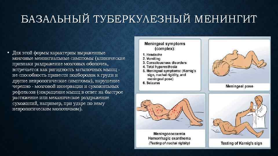 Туберкулезный менингит