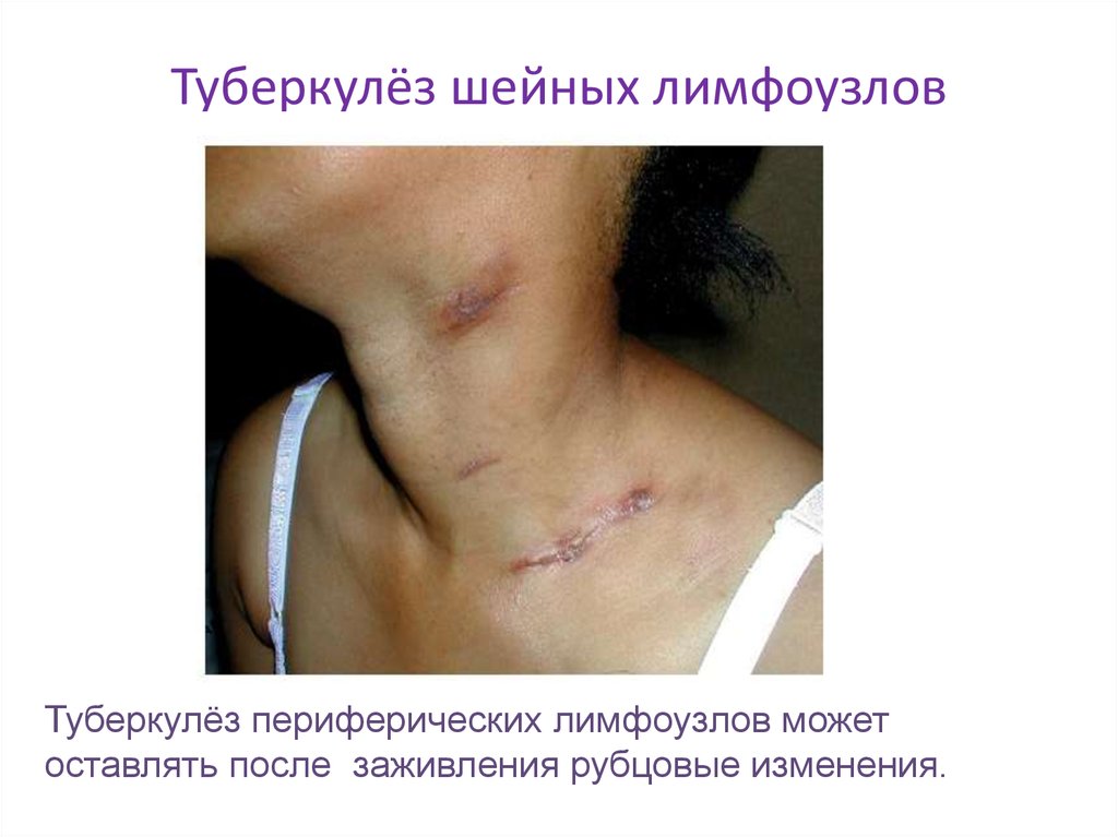 Туберкулез лимфоузлов