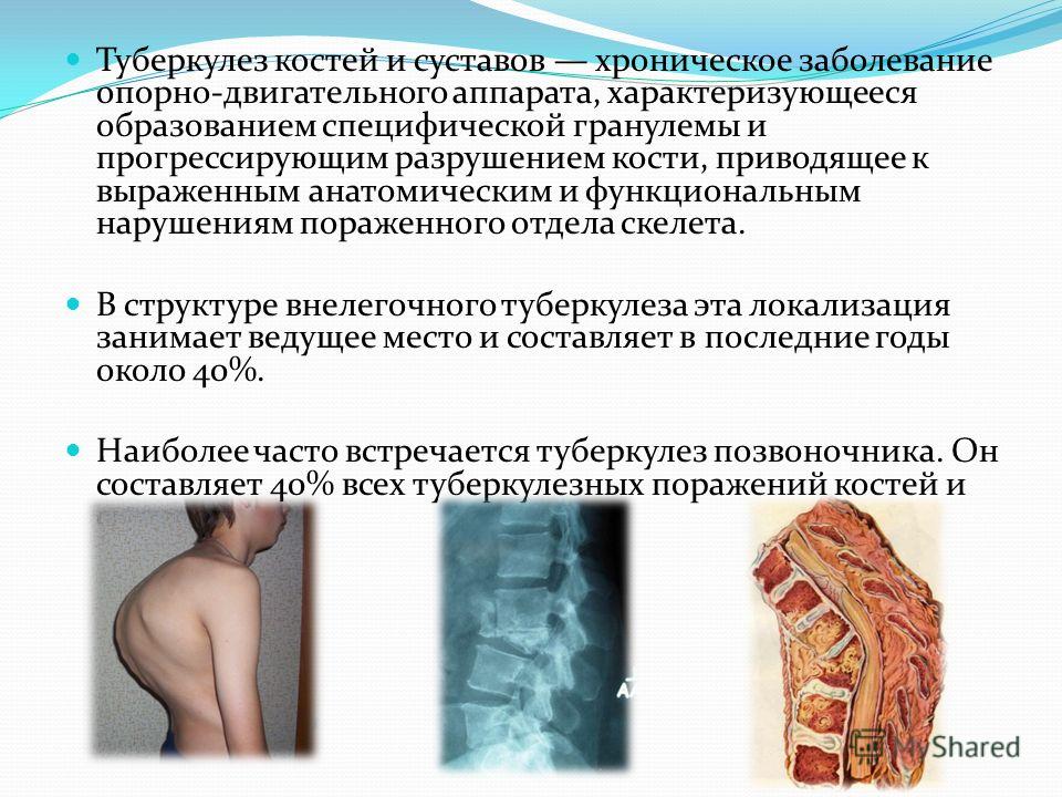 Туберкулез костей