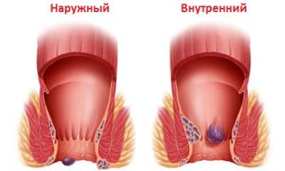 Виды геморроя