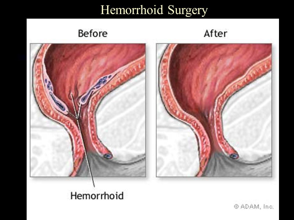 Тромбофлебит заднего прохода. Тромбоз внешнего геморроидального узла. Геморрой после операции. Геморрой до и после операции.