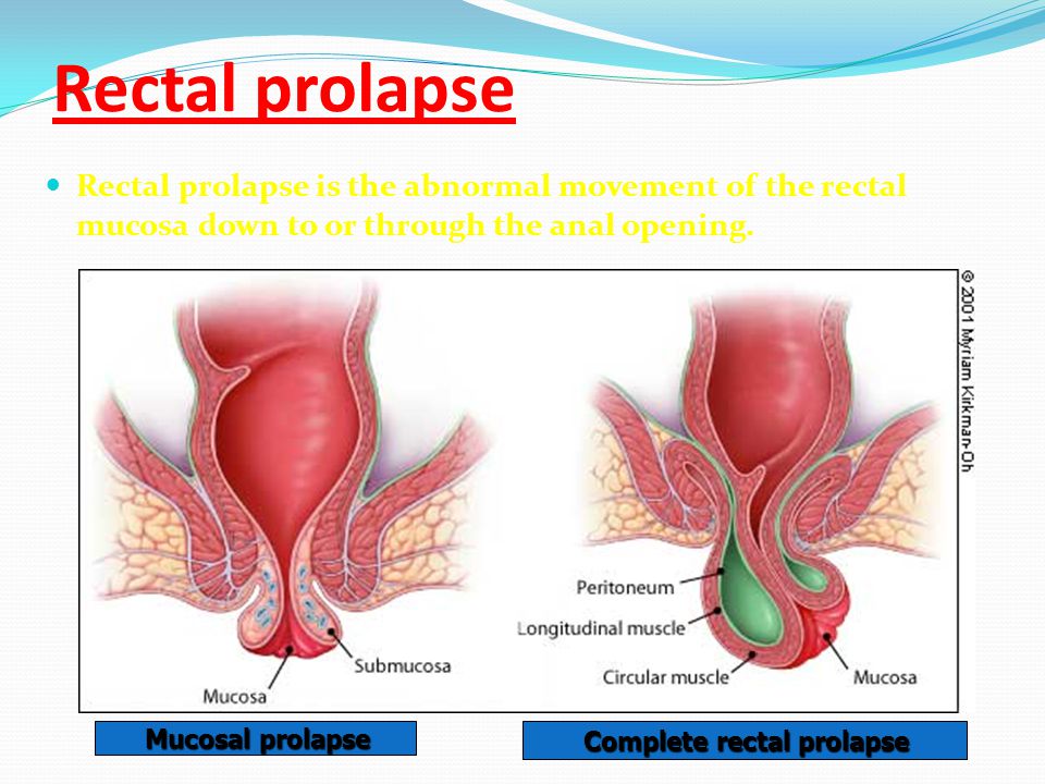 Weightlifter Rectal Prolapse