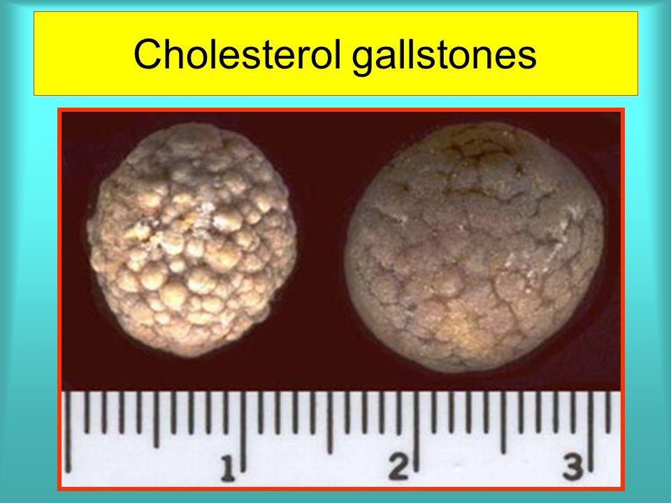 При каком размере камней в желчном. Холестериновые камни в желчном. Известковые камни в желчном пузыре. Камни из желчного пузыря холестериновые. Холестериновые камни в почках.