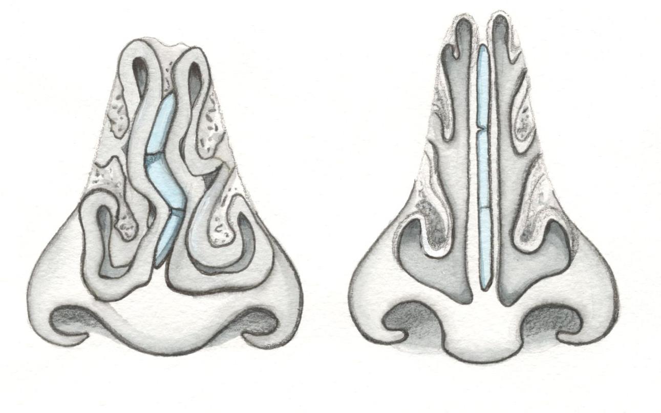 Носовой. Анатомия искривлённой носовой перегородки. Носовой хрящ септопластика. Патология искривление носовой перегородки. Искривленная перегородка носа.