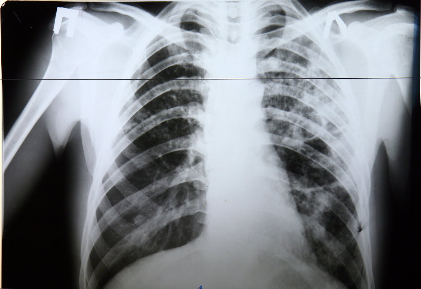 Начальная стадия туберкулеза у взрослых. Туберкулез последняя стадия. Последняя стадия туберкулёза лёгких фото. Туберкулез последняя стадия фото. Легкие при туберкулезе фото.