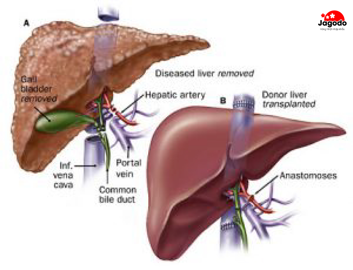 Гепатит желчный пузырь. Гетеротопическая трансплантация печени. Трансплантация печени ход операции. Ортотопической трансплантации печени.