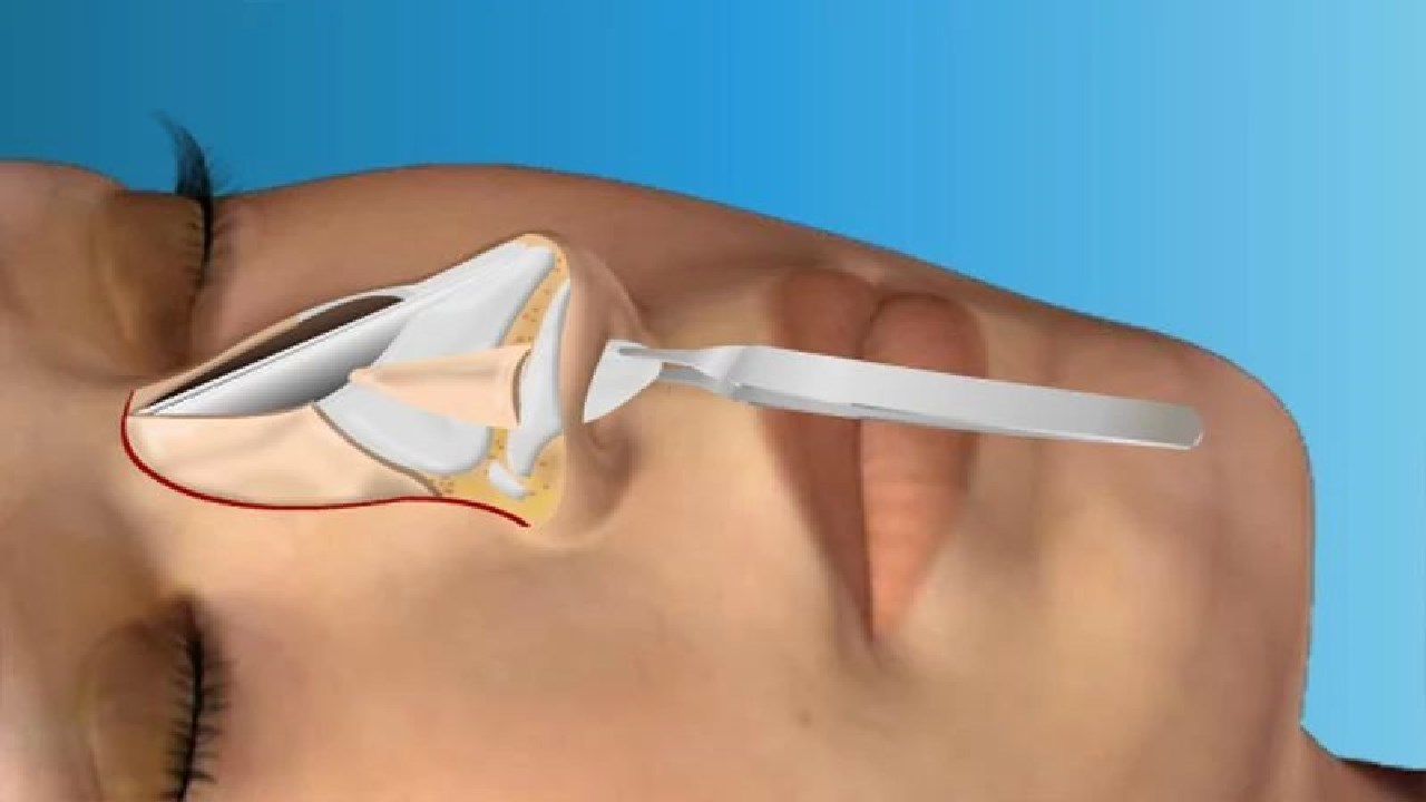 Септопластика носа. Септотомия носовой перегородки что это. Выпрямление носовой перегородки. Операция на перегородку носа. Выправление носовой перегородки.